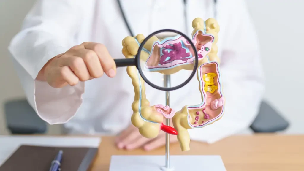 enfermedad-del-colon-intestino-grueso-cancer-colorrectal_6cb54999_1698693837_250604122511_1280x720 ‣ Українські новини Методи лікування раку кишечника Рак кишечника: діагностика та лікування