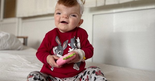 Нейрохірурги Львова відновили череп однорічної дівчинки з Рівненської області.